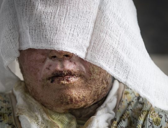 WomensÕ self-immolation as a result of domestic violence is an epidemic in Kurdistan. Ready access to kerosene and the emotional power of the act itself are the main drivers. Sulaymaniyah Emergency Hospital burns unit is the countryÕs main public centre for treatment. Srwa Jumaa Kareem, 30, suffered 53% burns which she say occurred as a result of a gas explosion. Hospital staff explained that she was in fact a victim of kerosene burns most likely as a result of self immolation or domestic assault. Many families misreport because of the associated stigma.