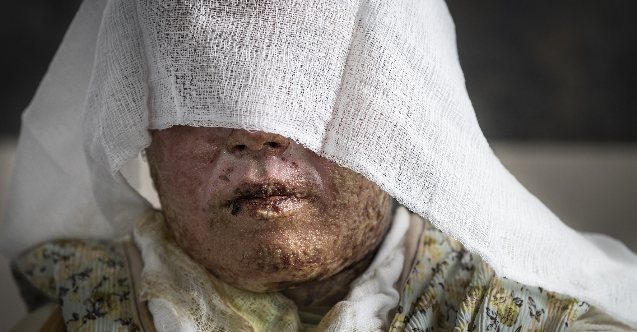 WomensÕ self-immolation as a result of domestic violence is an epidemic in Kurdistan. Ready access to kerosene and the emotional power of the act itself are the main drivers. Sulaymaniyah Emergency Hospital burns unit is the countryÕs main public centre for treatment. Srwa Jumaa Kareem, 30, suffered 53% burns which she say occurred as a result of a gas explosion. Hospital staff explained that she was in fact a victim of kerosene burns most likely as a result of self immolation or domestic assault. Many families misreport because of the associated stigma.